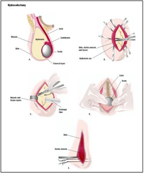 Hydrocele